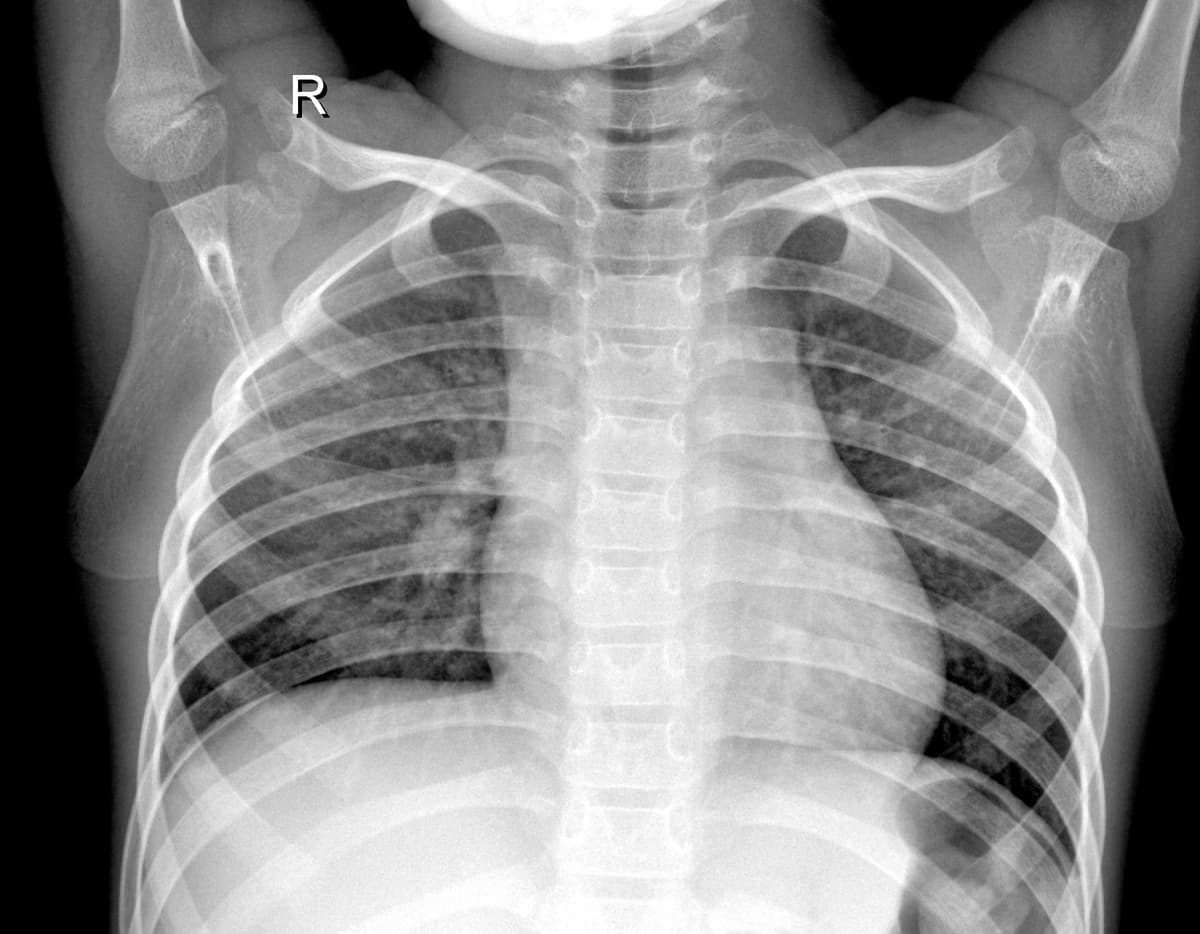 Radiografia Normal — NIH Chest X-ray14