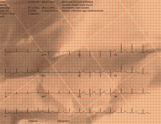 Normal ECG — PTB-XL
