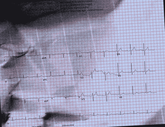 Normal ECG — PTB-XL