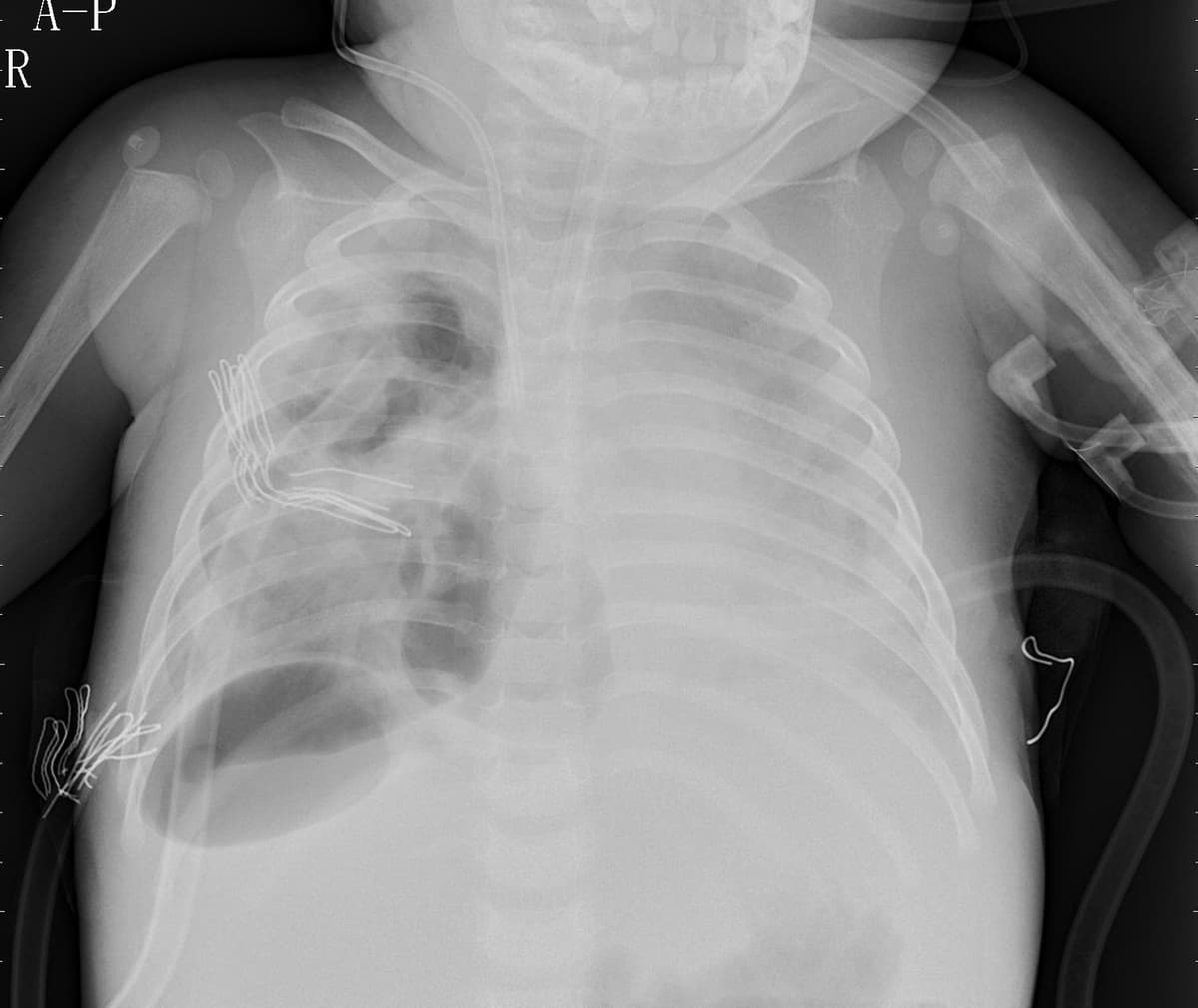 Pneumonia — NIH Chest X-ray14