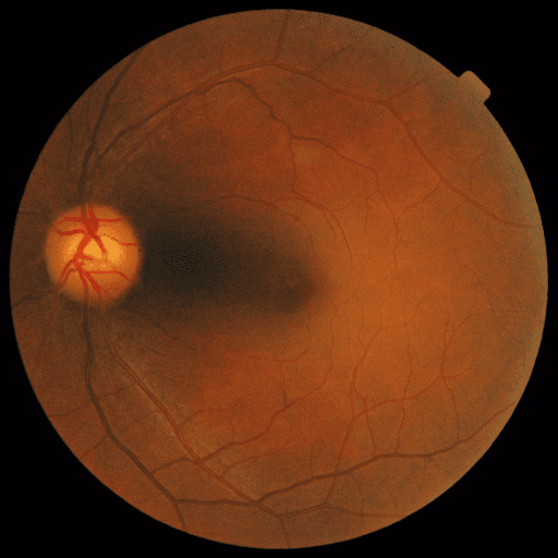 No Diabetic Retinopathy — MESSIDOR-2