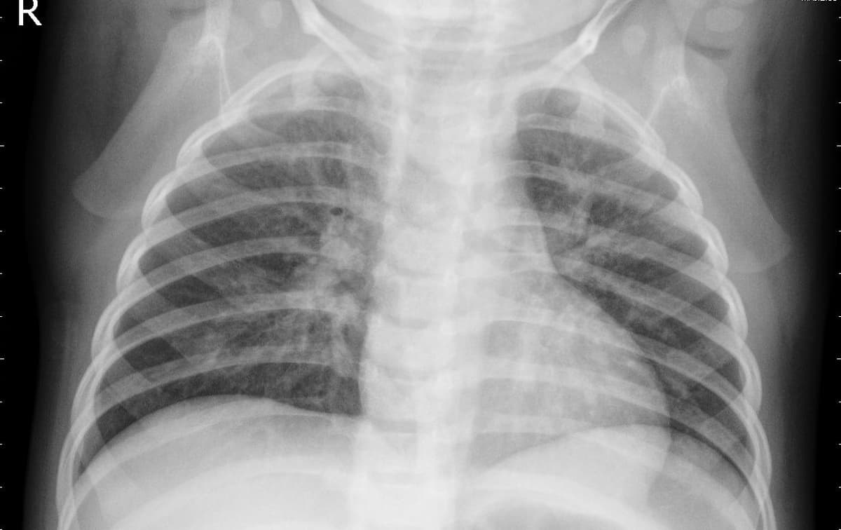 Pneumonia — NIH Chest X-ray14