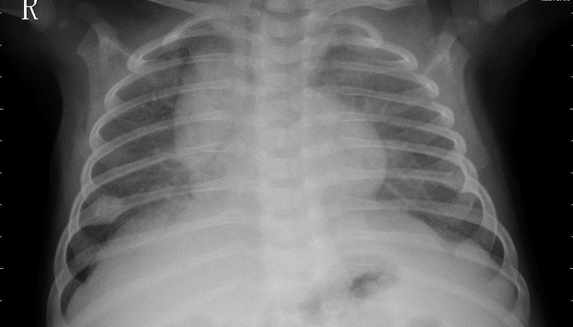 Pneumonia — NIH Chest X-ray14