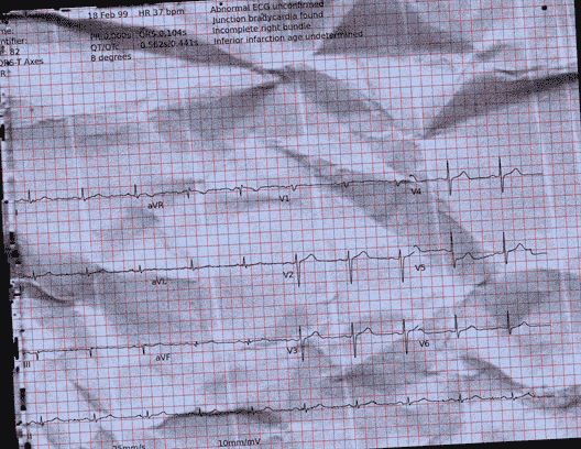 Normal ECG — PTB-XL