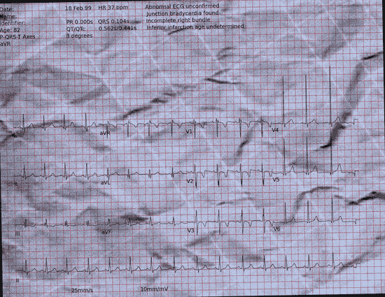 Normal ECG — PTB-XL