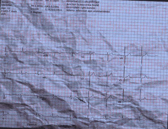 Normal ECG — PTB-XL