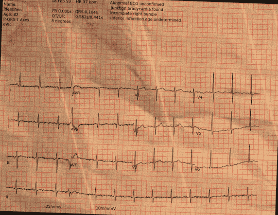 Normal ECG — PTB-XL