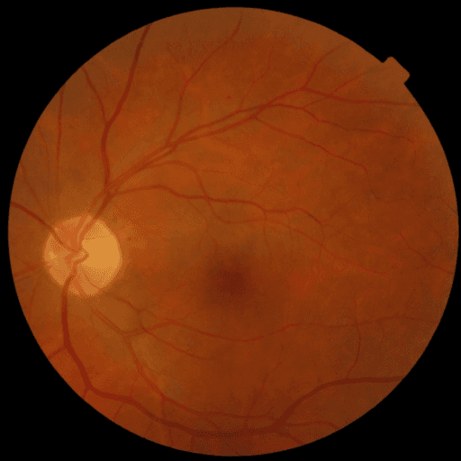 No Diabetic Retinopathy — MESSIDOR-2