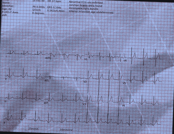 Normal ECG — PTB-XL