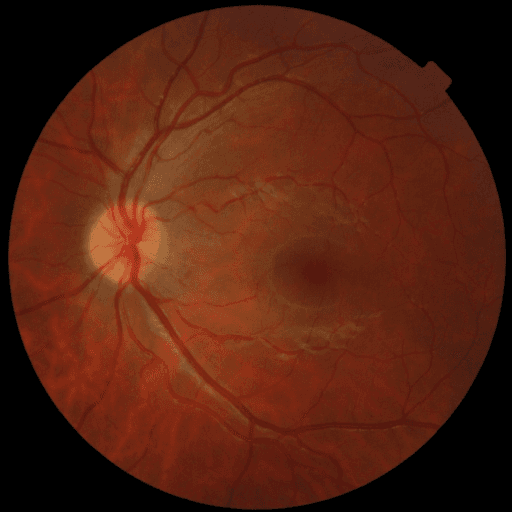 Proliferative DR — MESSIDOR-2