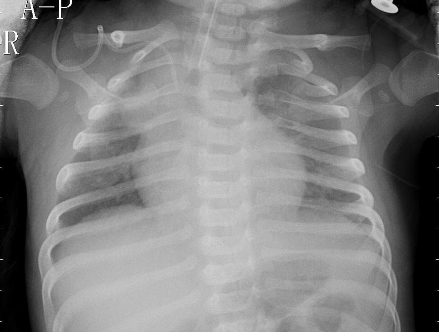 Pneumonia — NIH Chest X-ray14