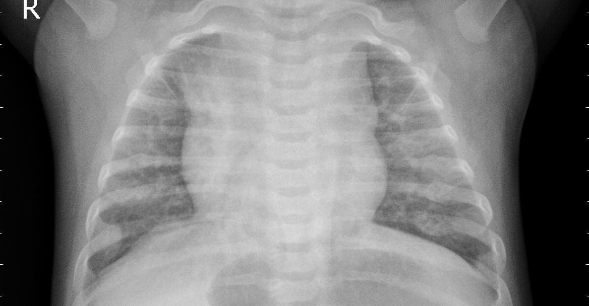 Pneumonia — NIH Chest X-ray14