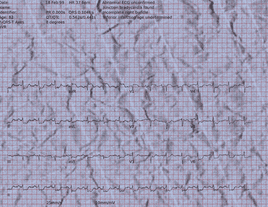 Normal ECG — PTB-XL