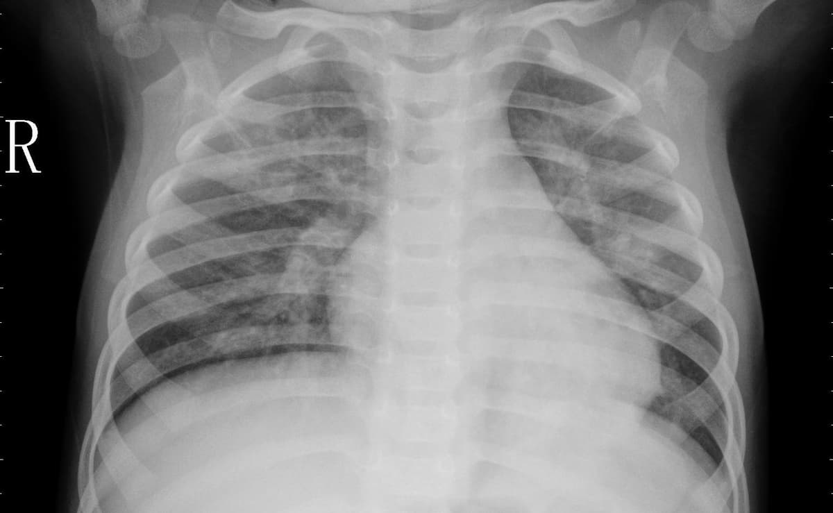 Pneumonia — NIH Chest X-ray14