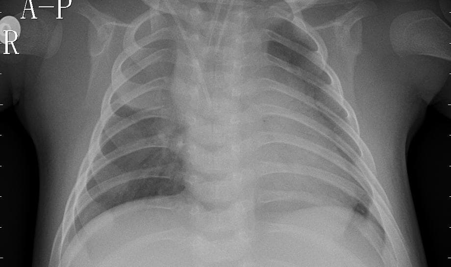Pneumonia — NIH Chest X-ray14