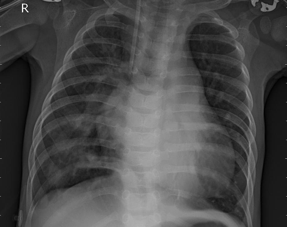 Pneumonia — NIH Chest X-ray14