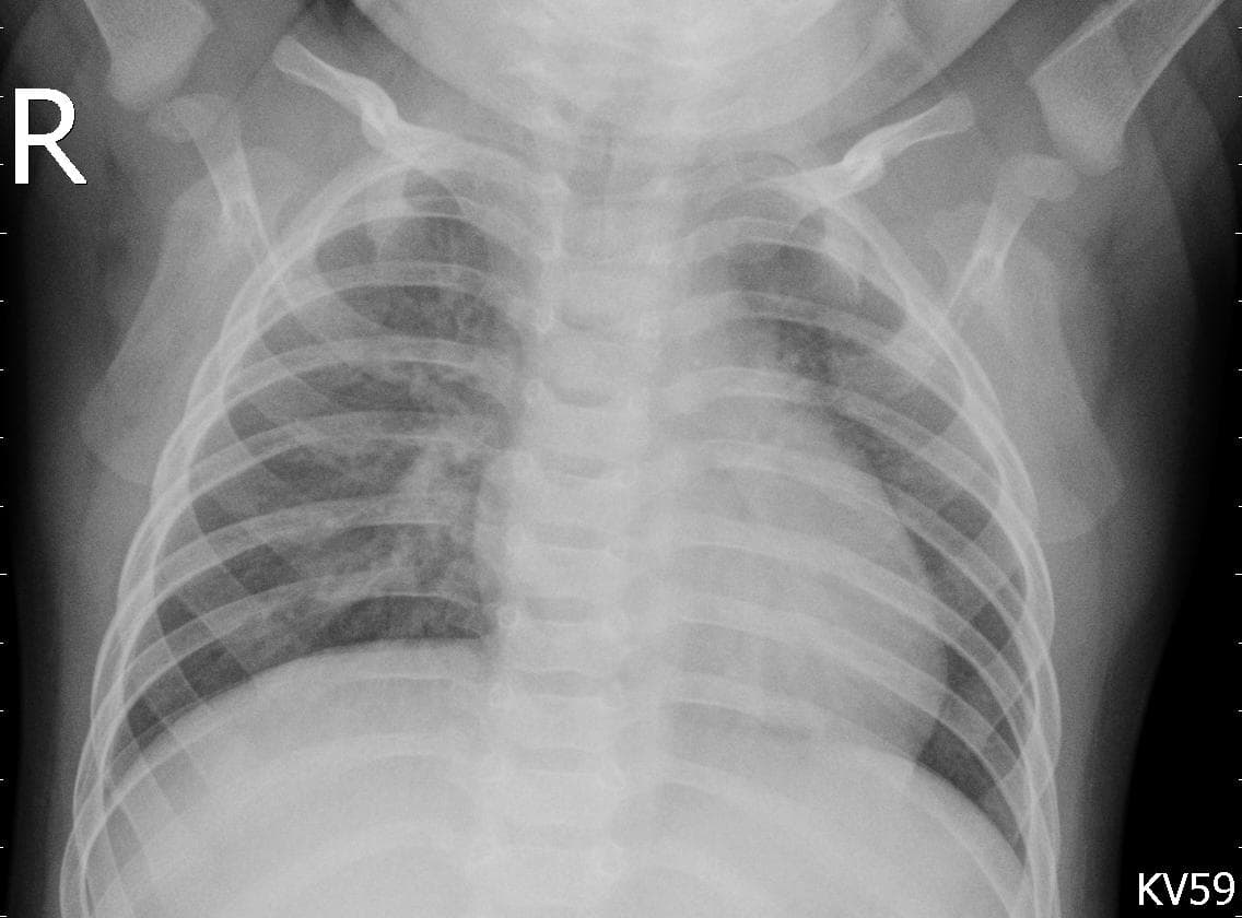 Pneumonia — NIH Chest X-ray14