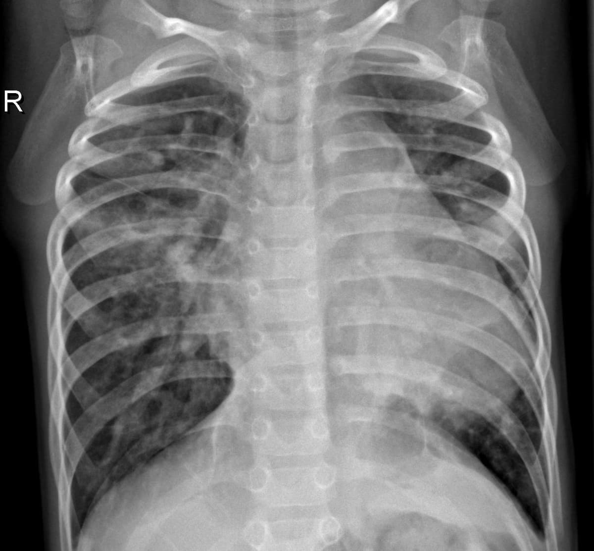 Pneumonia — NIH Chest X-ray14