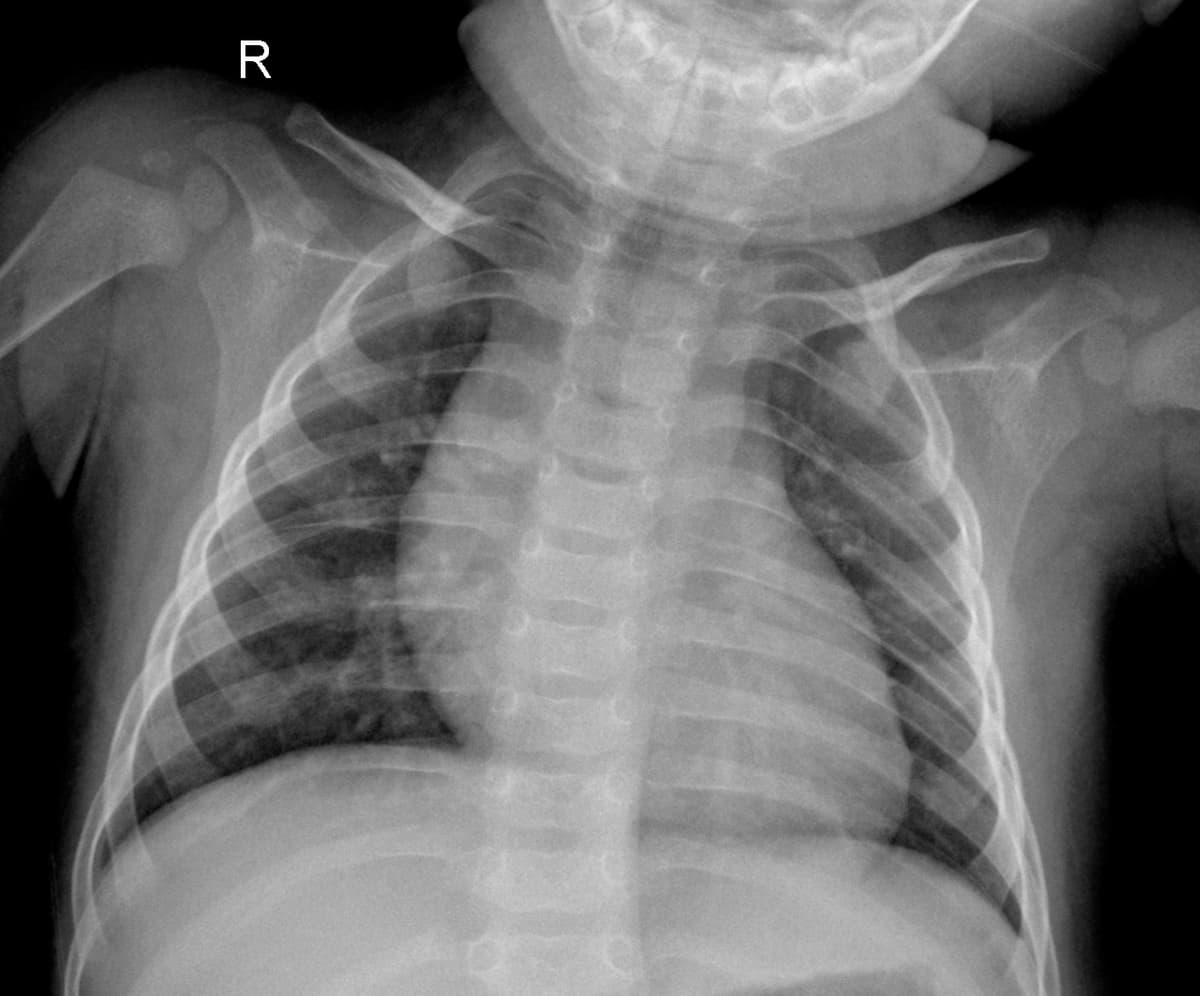 Radiografia Normal — NIH Chest X-ray14