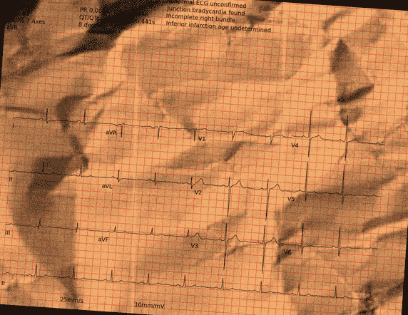 Normal ECG — PTB-XL