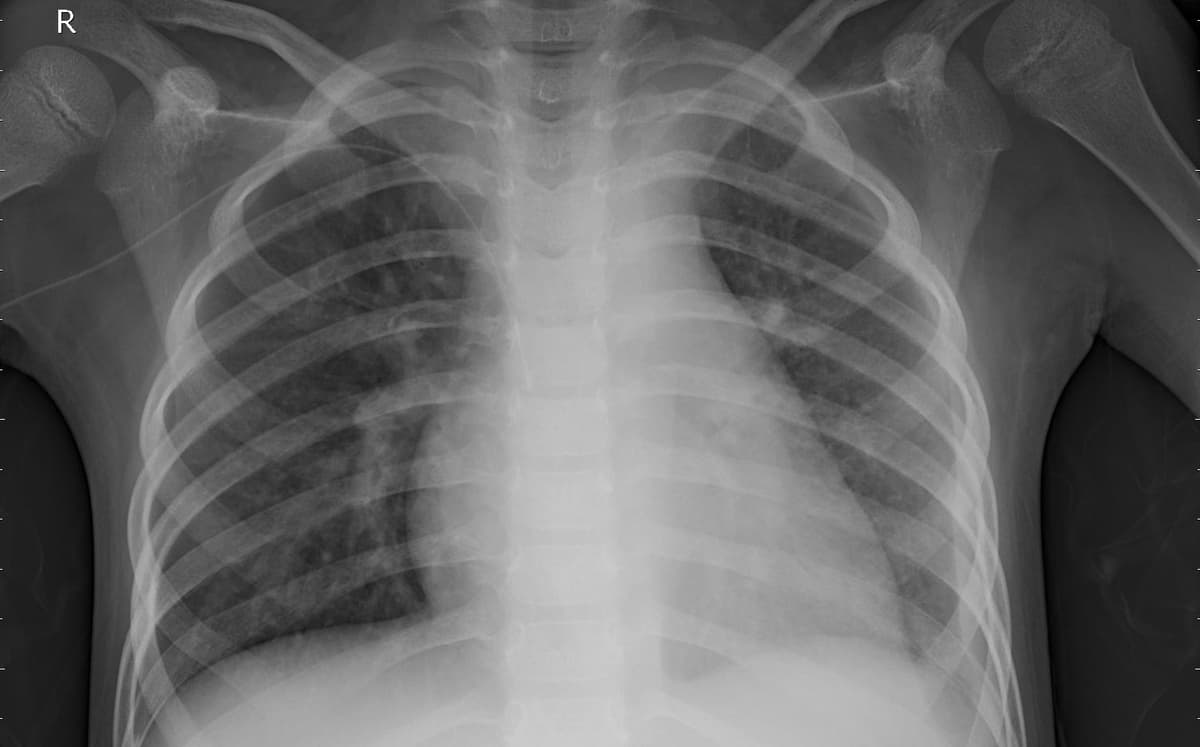 Pneumonia — NIH Chest X-ray14