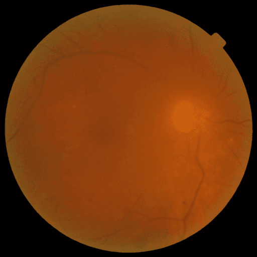 No Diabetic Retinopathy — MESSIDOR-2