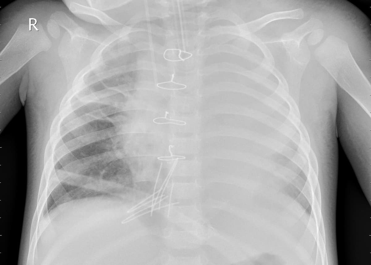 Pneumonia — NIH Chest X-ray14