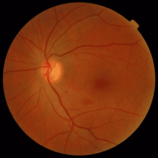 No Diabetic Retinopathy — MESSIDOR-2