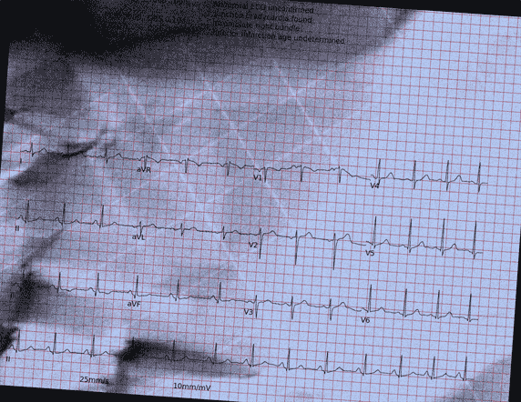 Normal ECG — PTB-XL