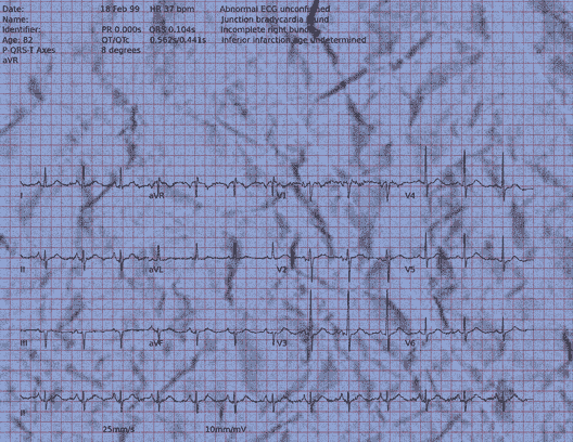 Normal ECG — PTB-XL