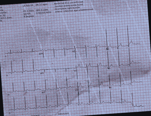 Normal ECG — PTB-XL