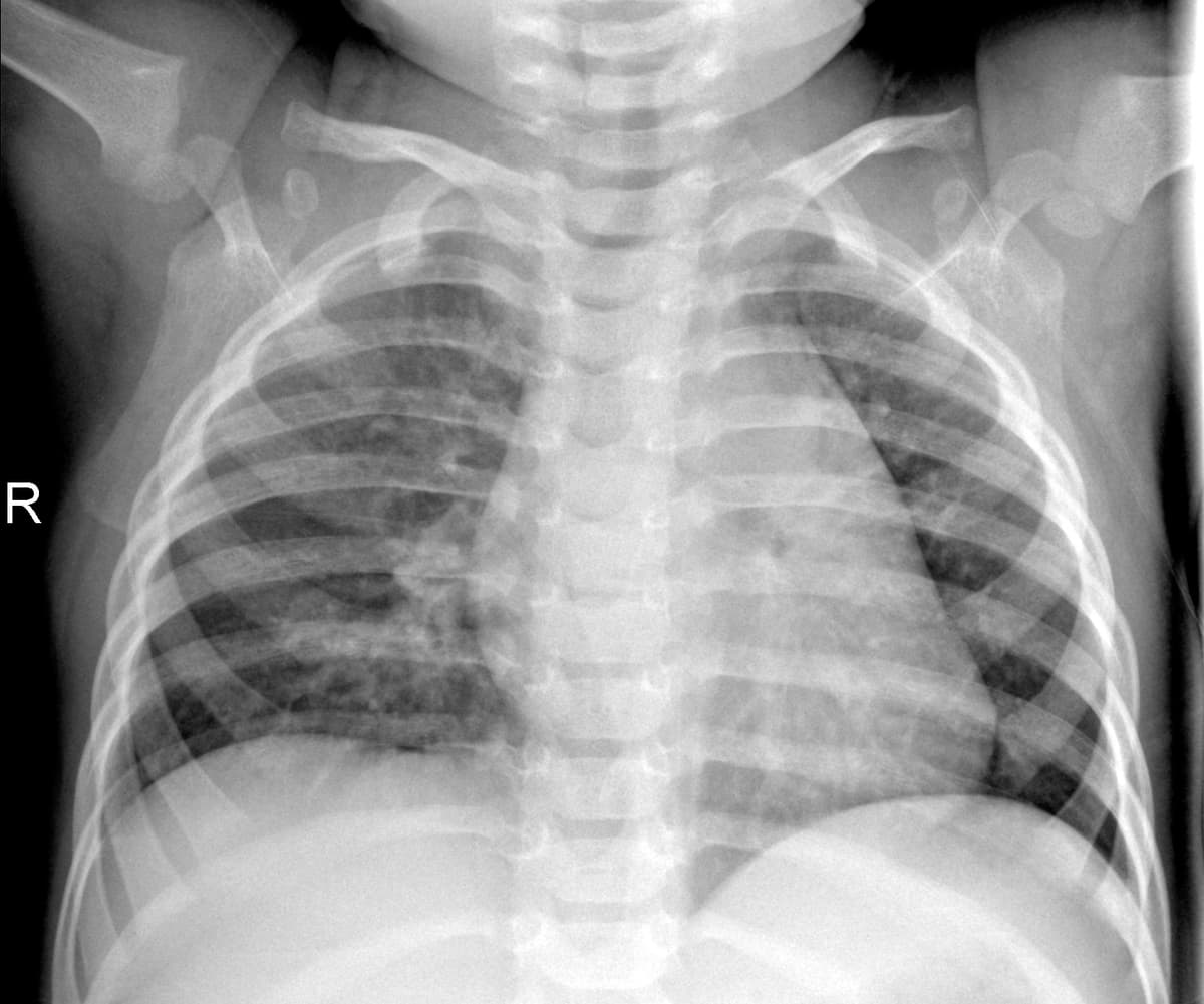 Radiografia Normal — NIH Chest X-ray14