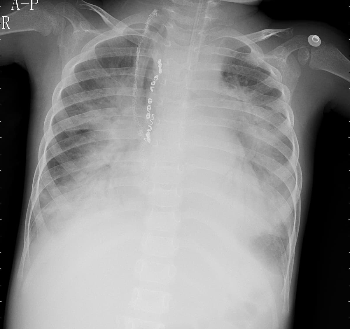 Pneumonia — NIH Chest X-ray14