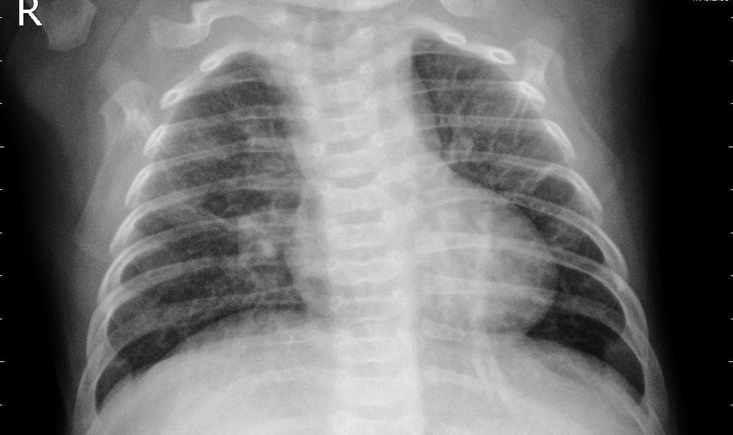 Pneumonia — NIH Chest X-ray14
