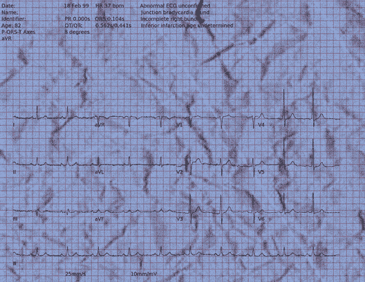 Normal ECG — PTB-XL