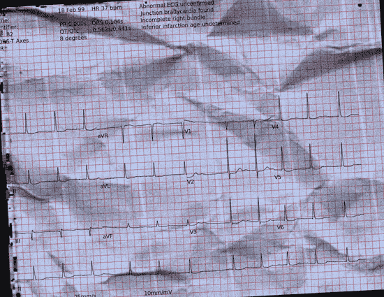 Normal ECG — PTB-XL