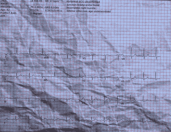 Normal ECG — PTB-XL