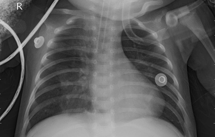 Pneumonia — NIH Chest X-ray14