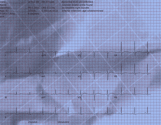 Normal ECG — PTB-XL