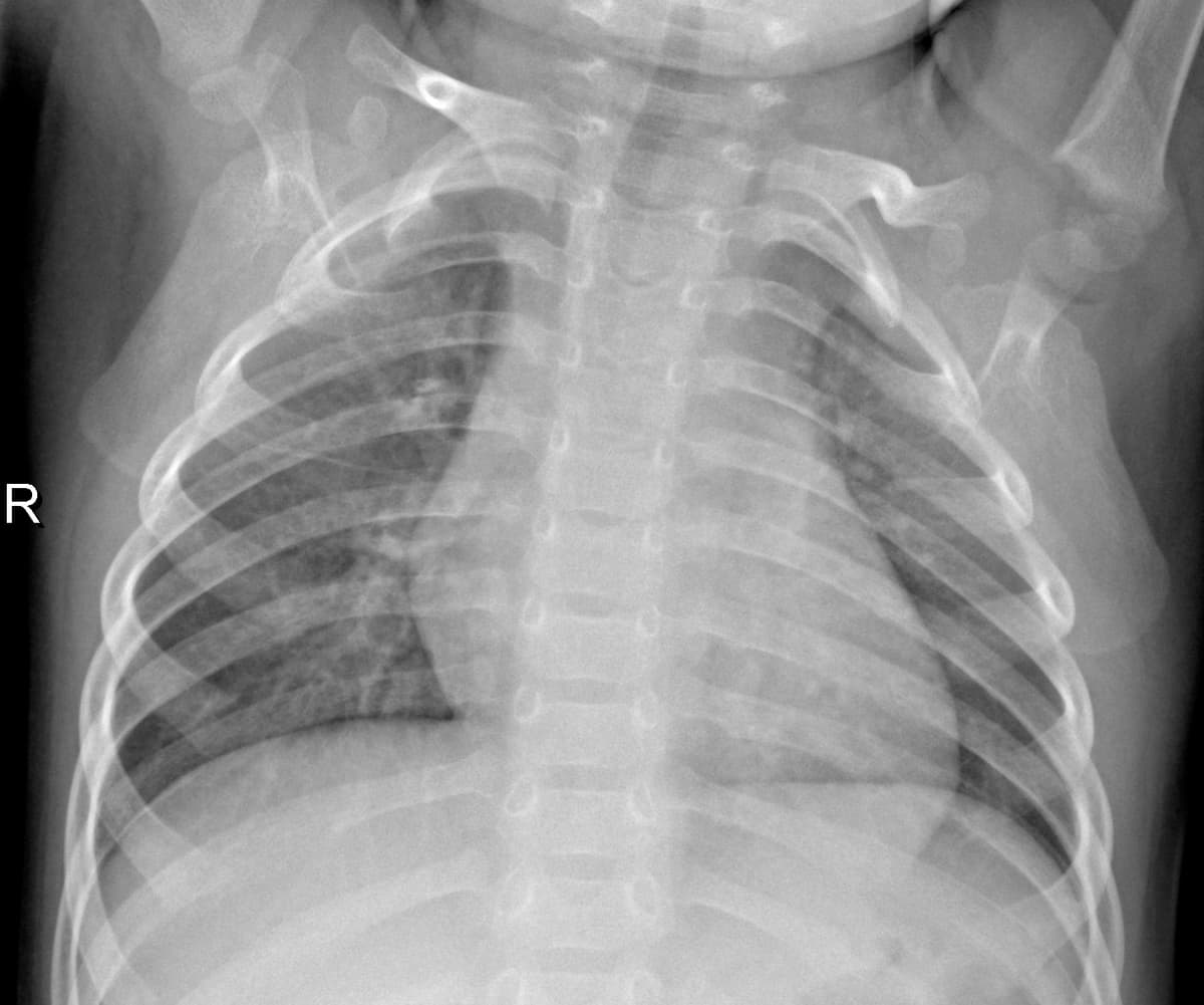 Radiografia Normal — NIH Chest X-ray14