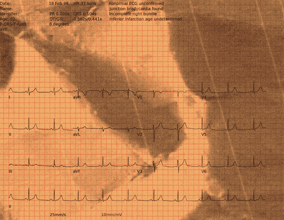 Normal ECG — PTB-XL