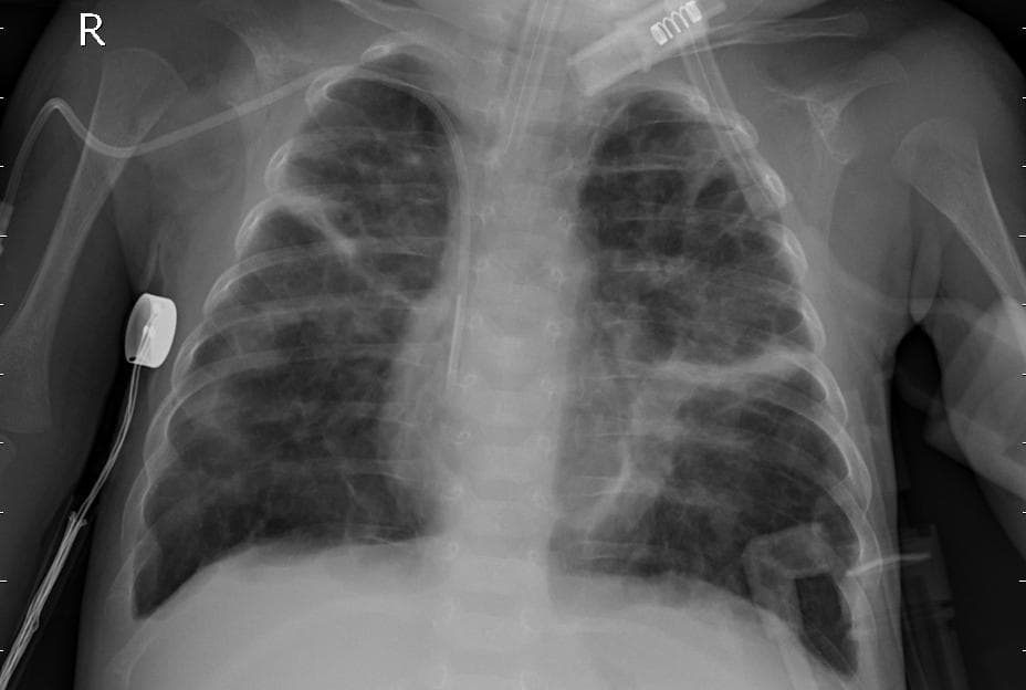 Pneumonia — NIH Chest X-ray14