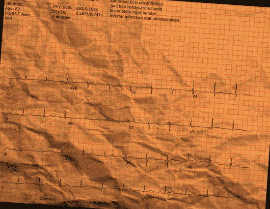 Normal ECG — PTB-XL