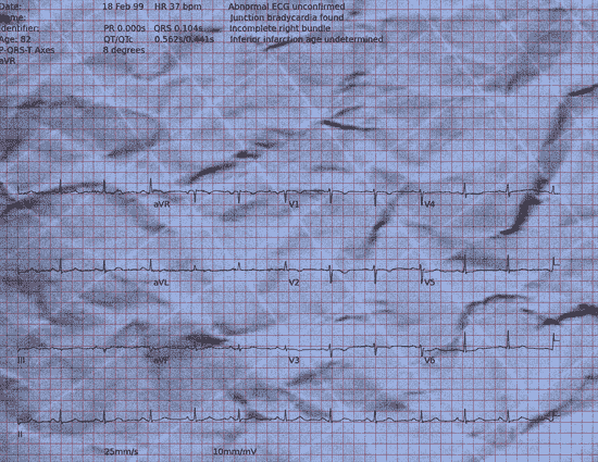 Normal ECG — PTB-XL