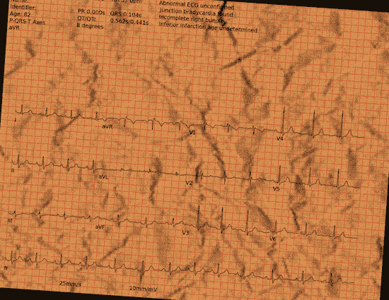 Normal ECG — PTB-XL
