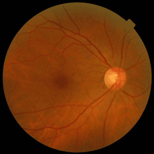 No Diabetic Retinopathy — MESSIDOR-2