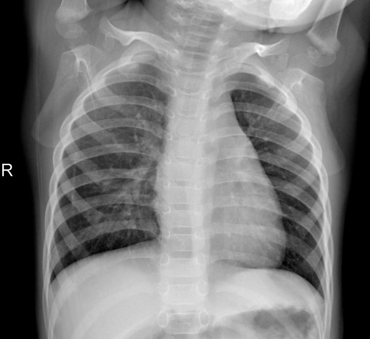 Radiografia Normal — NIH Chest X-ray14