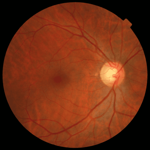 No Diabetic Retinopathy — MESSIDOR-2