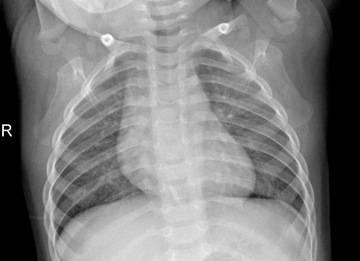 Radiografia Normal — NIH Chest X-ray14