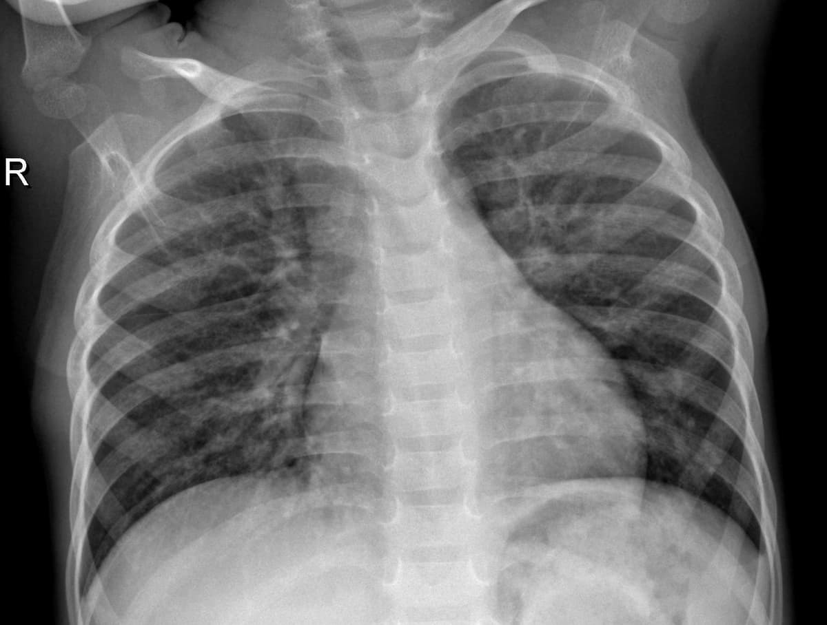 Pneumonia — NIH Chest X-ray14